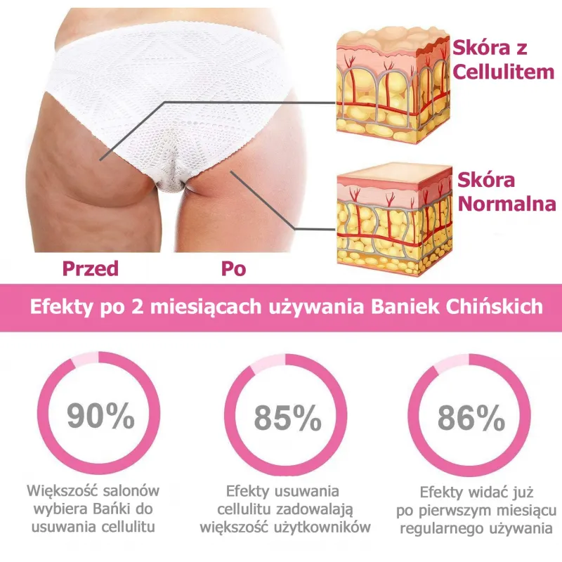 Bańki Chińskie + zestaw antycellulitowy Przed i Po masażu