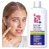 STOP Demodex Tonic Face Tonic for nausea acne blackheads - Laroxy.com