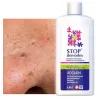 STOP Demodex Tonic Face Tonic for nausea acne blackheads - Laroxy.com