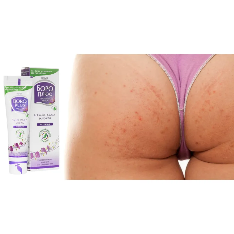 BORO PLUS HERBAL Maść na krosty na pupie pryszcze wypryski na pośladkach bolące z cynkiem 25ml